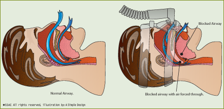 illustration of CPAP
