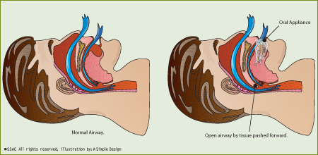 illustration of an Oral Appliance
